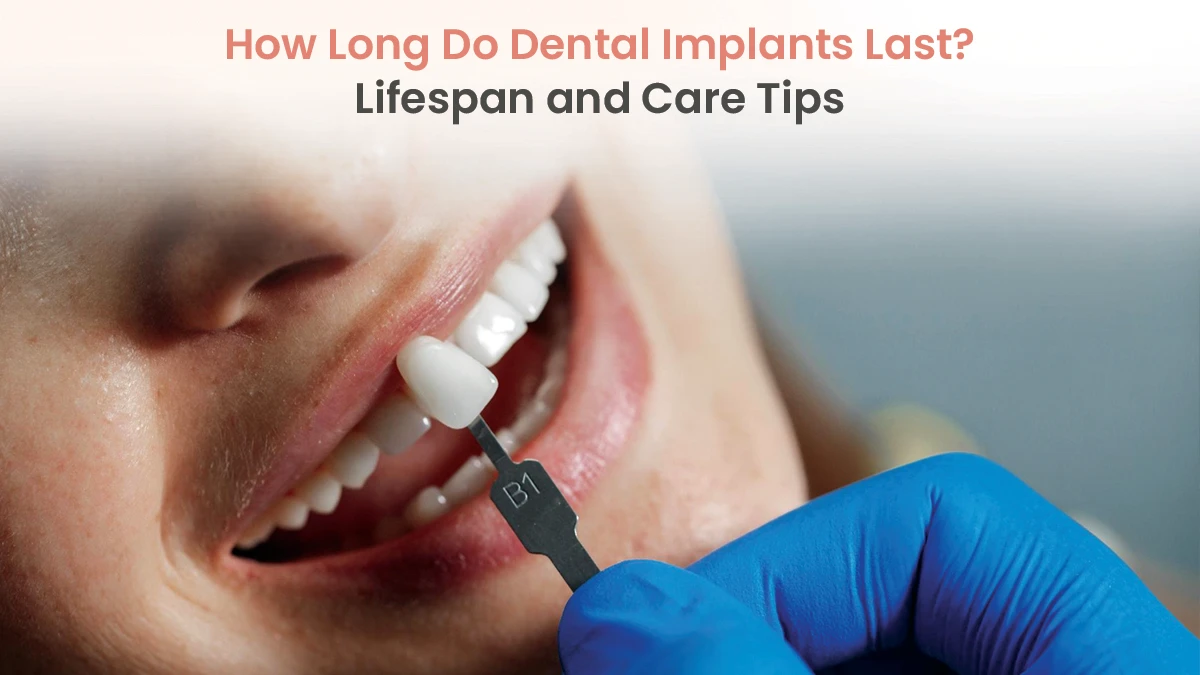 How Long Do Dental Implants Last? Lifespan and Care Tips